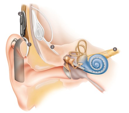 Cochlear Implant Explained